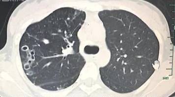万恶的肺吸虫病,影像竟是这样的