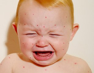 麻疹、荨麻疹、风疹、水痘!看图长点知识