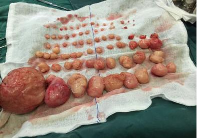 子宫里的74个"偷渡客",浆膜下子宫肌瘤图片,子宫肌瘤