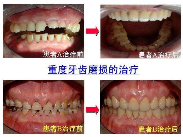 牙齿磨损(磨耗)及其防治