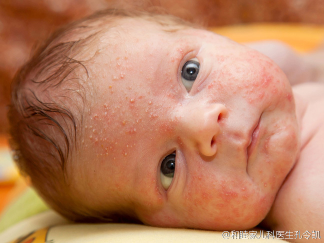 新生儿面部疱疹的鉴别与治疗