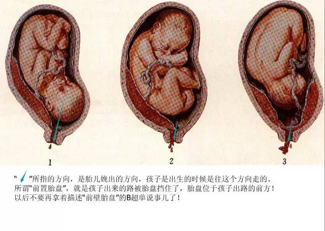 临床上,用力阵大便搞来大出血的前置胎盘还真不鲜见.