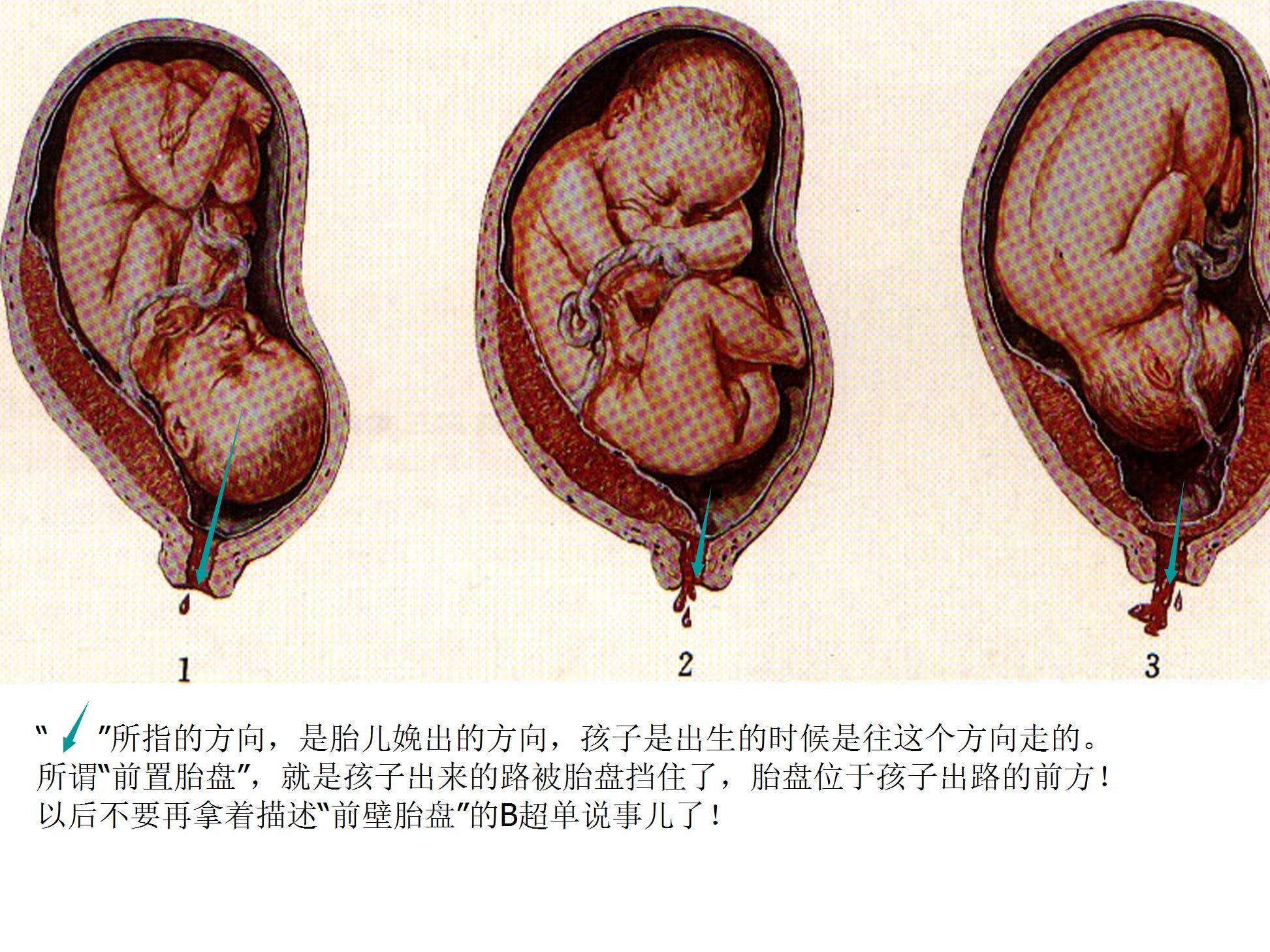 明明白白做超声(十七)：胎盘异常的超声显像检查之二——前置胎盘 - 知乎