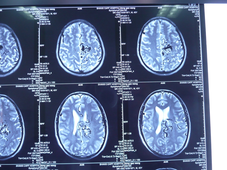 mri t1&t2(轴位,冠状位,矢状位)病灶信号不均,有广泛圆形,条索样