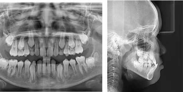 【正畸案例】别错过孩子矫正牙齿的最佳时期