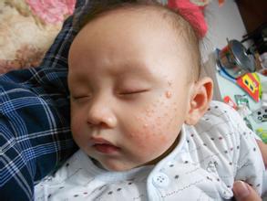 必荐:婴儿湿疹防治7个绝招