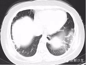 非常细致的结节病的ct诊断,你身边的朋友都在看