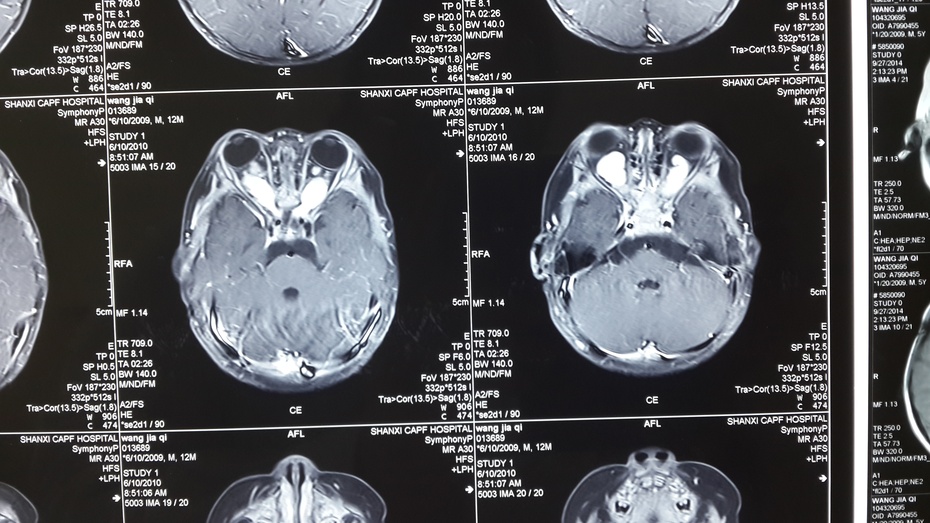 儿童脑瘤治疗实例双侧视神经胶质瘤