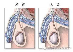 女人上环危害多,男人结扎就好么?