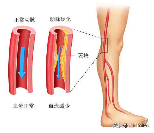 下肢动脉闭塞的早期信号:间歇性跛行