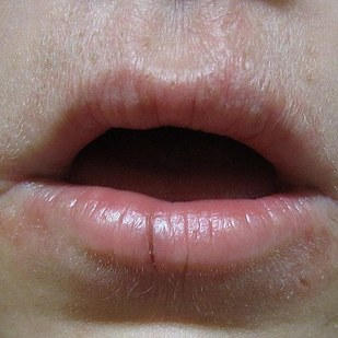 或涂新口红后发现嘴唇肿胀,需要立即就医,并在确诊之后进行抗过敏治疗