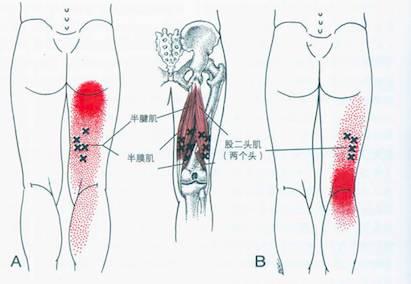 腘窝处疼痛的常见原因