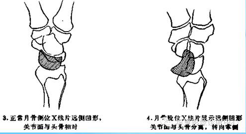 健康 正文  月骨周围脱位和月骨脱位占腕部损伤的10%,发生机制是使腕