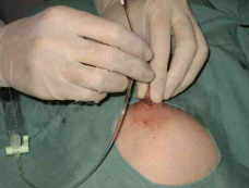 乳腺导管造影是将造影剂注入溢液导管后摄片,乳腺导管内乳头