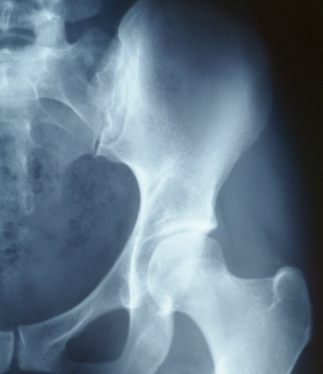 骨痛是多发性骨髓瘤的早期预警信号
