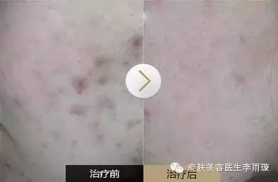 治疗手段:激光美容症状:红色痘印顾名思义,痘痕呈黄色,红色,淡褐色