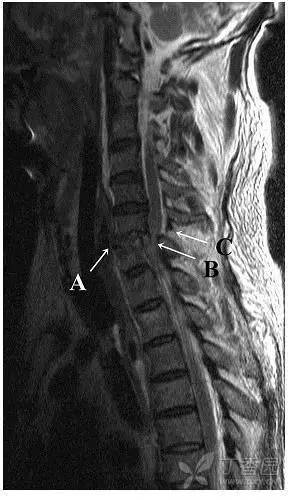 韩国学者 lee 等研究表明神经功能差和 mri 黄韧带损伤可预测颈椎