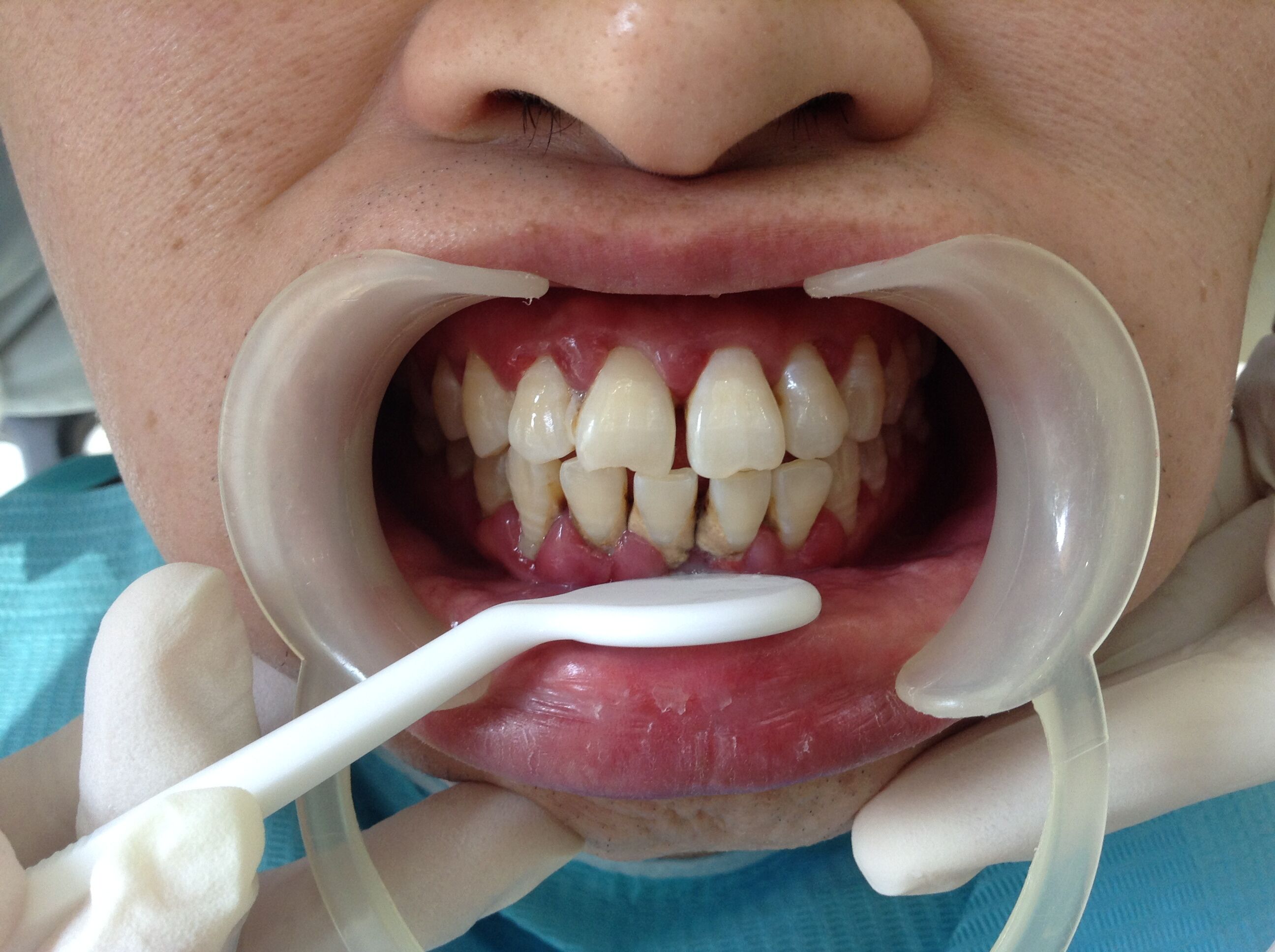 牙周病综合症牙周病治疗后牙龈恢复健康的颜色和形态_图片_互动百科