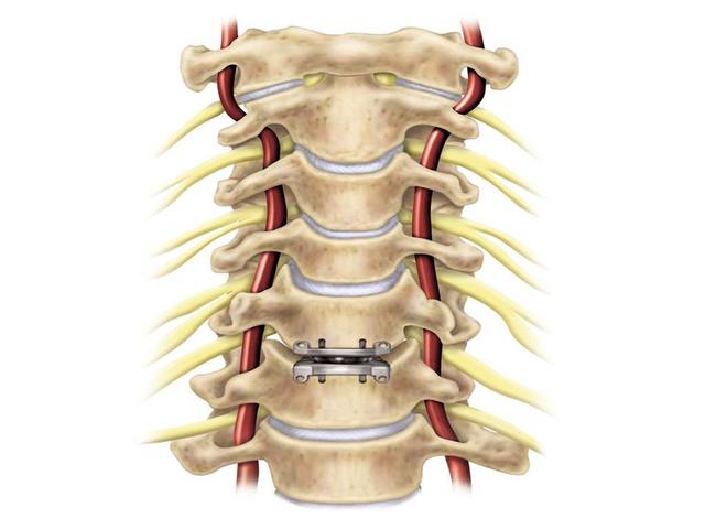 颈椎人工椎间盘置换术保留您颈椎的运动