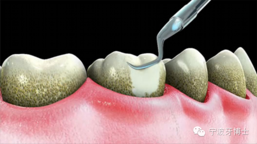 若牙周袋不是很深,在刮治过程中可能只有一丁点不适感,甚至可能会没