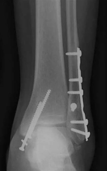 这种特殊的内踝骨折需要用钢板固定