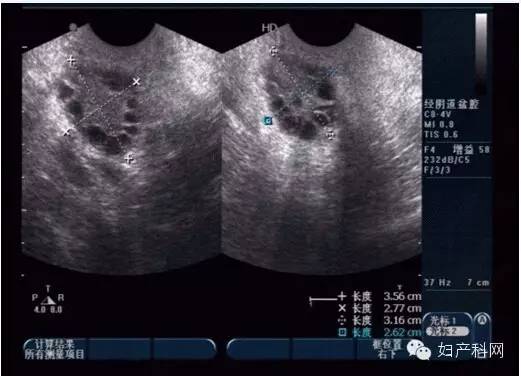 超声笔记no102不孕症卵泡监测