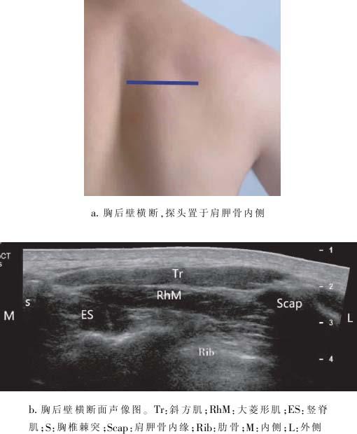 背阔肌:起于t7-t12棘突,腰筋膜,下4肋和后髂脊,止于肱骨二头肌间沟