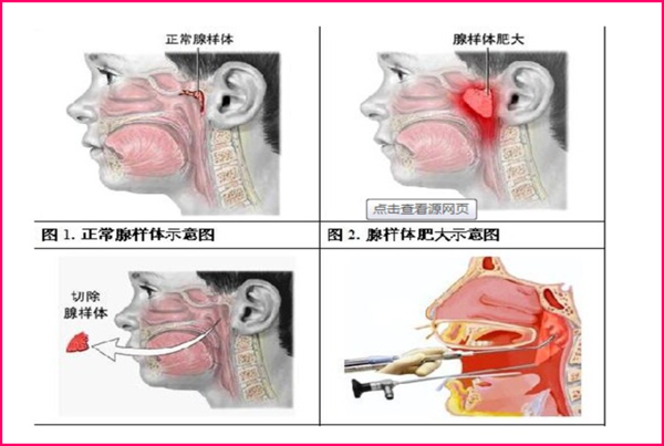 孩子得腺样体肥大的危害,妈妈了解多少?