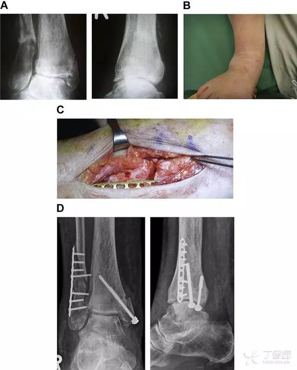 手把手教程:截骨矫形治疗踝关节骨折畸形愈合