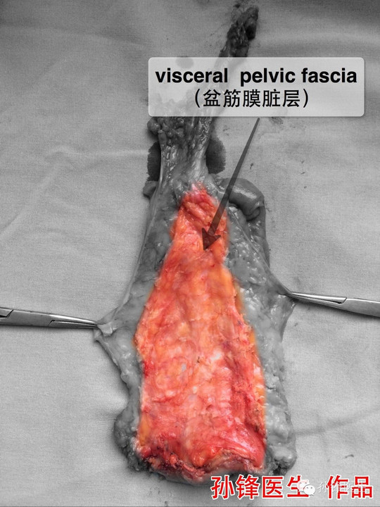 图(1:盆筋膜脏层(直肠标本)
