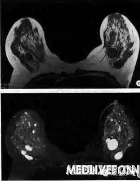 乳腺增生影像学诊断