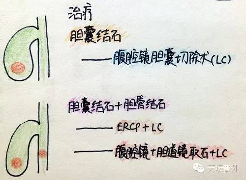 图说胆囊结石