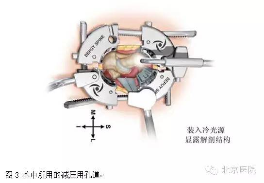 北京医院创伤小、恢复快、复发少的腰椎间盘突