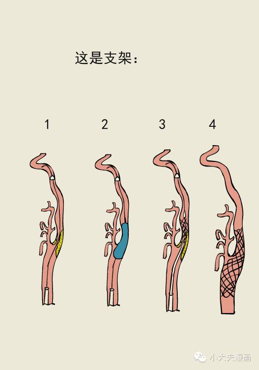 颈动脉狭窄:支架好还是内膜剥脱好?