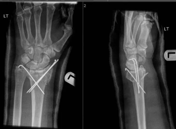 桡骨远端骨折治疗:掌侧钢板与克氏针各具优势