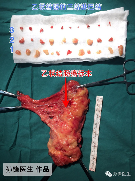 图(4:乙状结肠癌手术标本和三站淋巴结从根部结扎血管可以保证对以上