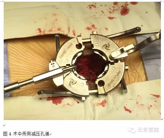 北京医院创伤小、恢复快、复发少的腰椎间盘突