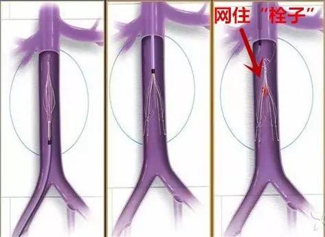 新技术丨老人突发下肢肿胀成大象腿情况危险