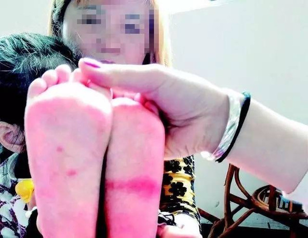 【热点】武汉3岁女童称脚底遭老师牙签扎,幼儿园否认?