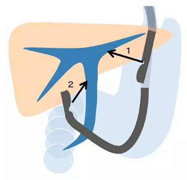 实用教程:超声内镜引导下胆汁引流术