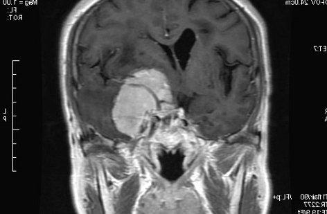 蝶骨嵴脑膜瘤导致的福斯特-肯尼迪综合征