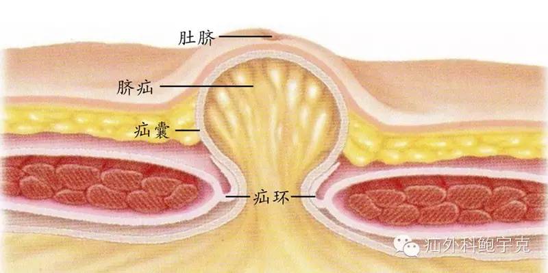 两招防嵌顿疝气患者假日必备技能