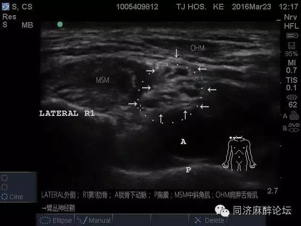 手把手教你"超声引导下臂丛神经阻滞"