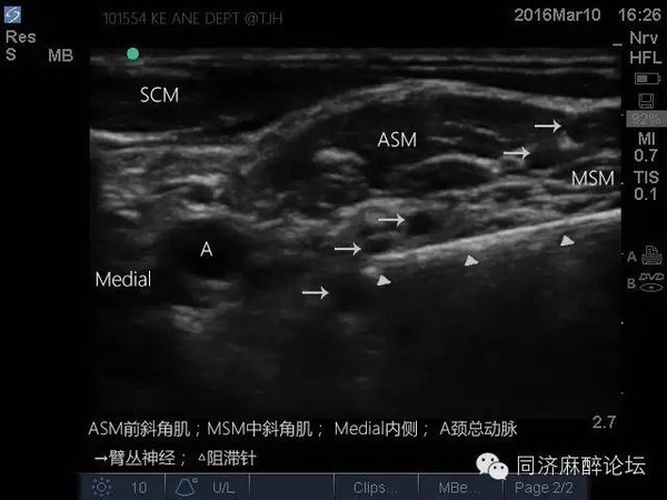 手把手教你超声引导下臂丛神经阻滞