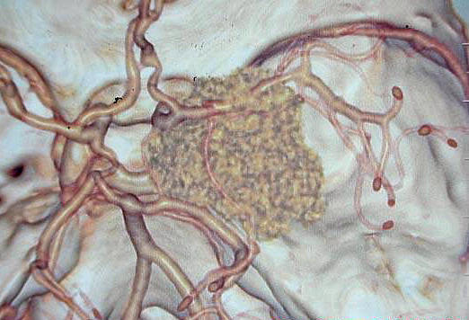蝶骨嵴脑膜瘤导致的福斯特-肯尼迪综合征
