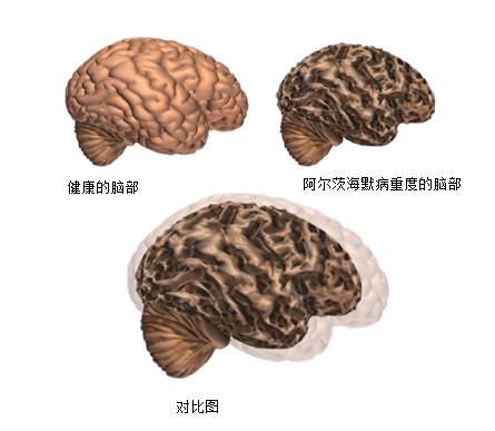 【组图】阿尔茨海默病患者脑部的变化