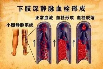 照看术后病人,预防血栓是关键!