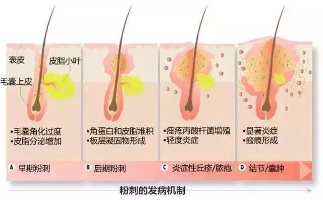 闭合性粉刺的原因和治疗方法
