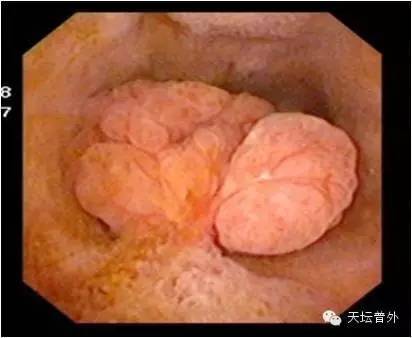 其实,胆囊常见的病变除了结石,还有胆囊息肉,那么,什么样的胆囊息肉又