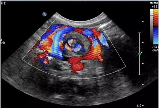 健康 正文  cdfi示包块内可见环形动静脉血流信号 鉴别诊断 肠旋转